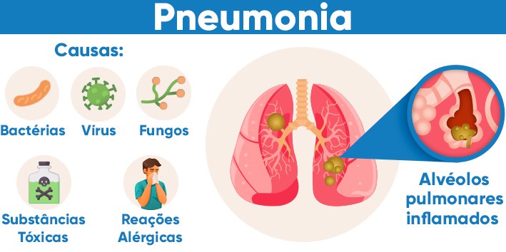 Pneumonia o que e bacterias virus fungos